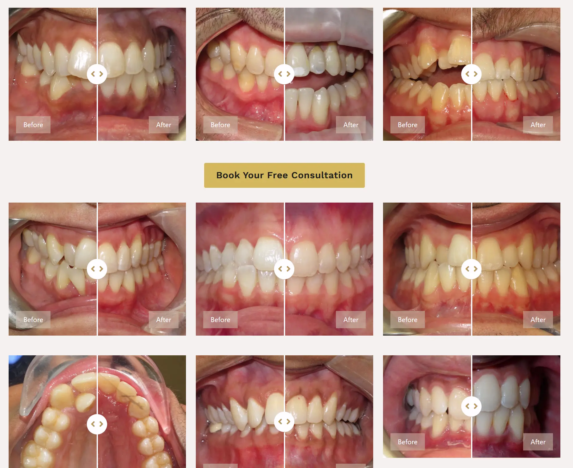 Gallery of before-and-after smile transformation cases from Mississauga Smiles Dentistry
